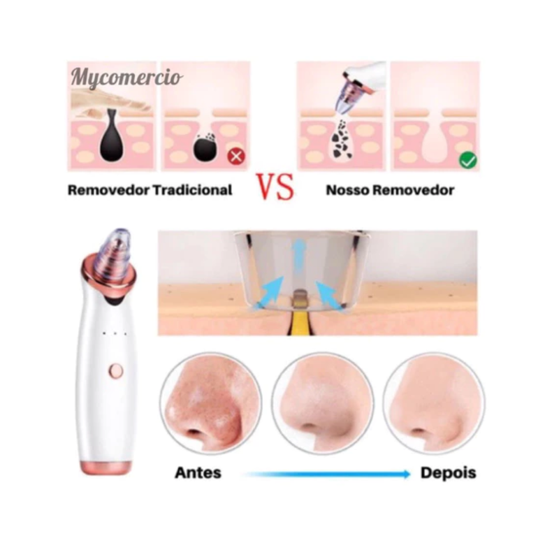 Removedor Cravos e Espinhas Sucção a Vácuo Aparelho Recarregável